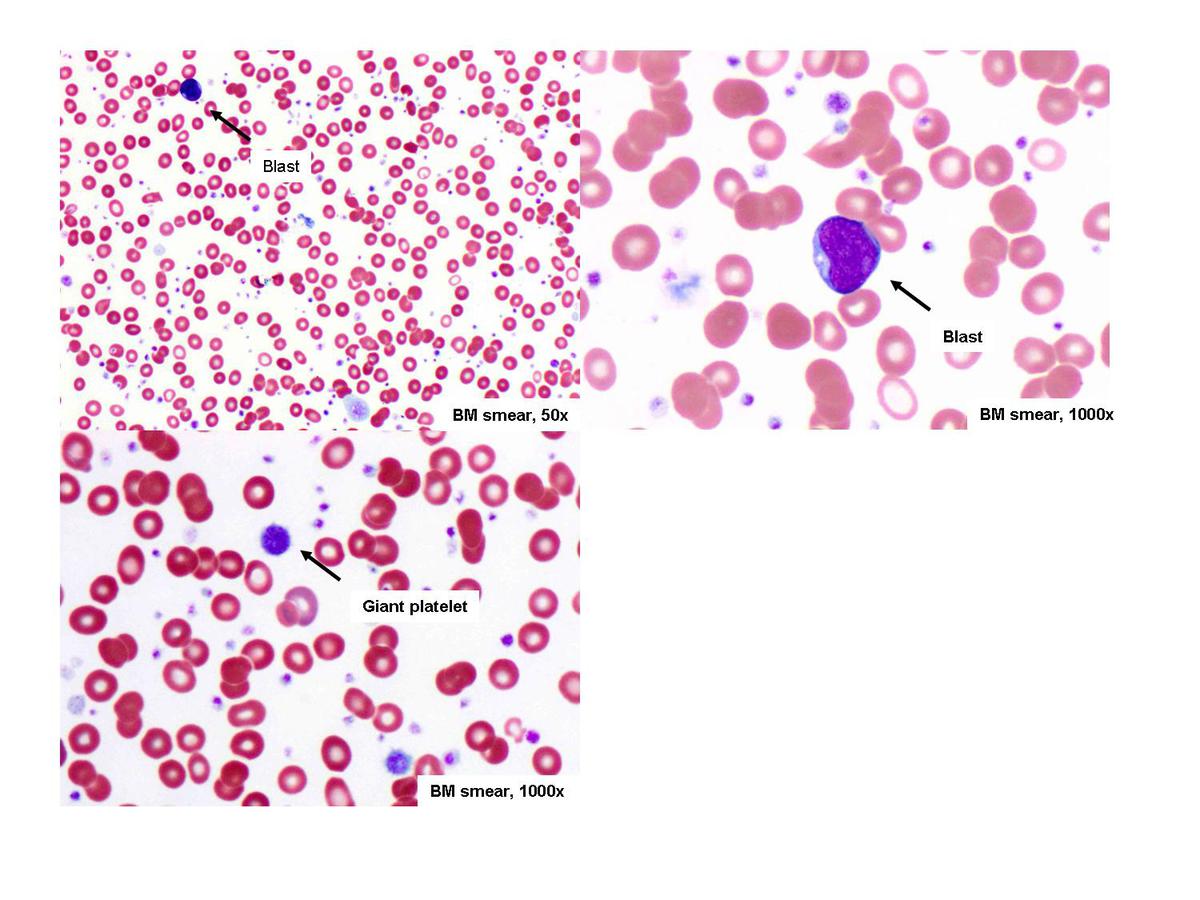 Peripheral blood smear